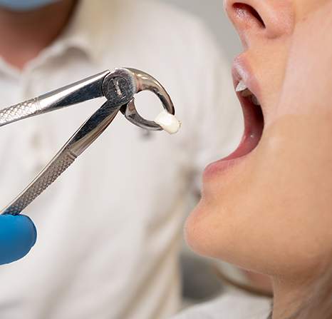 Close-up of an open mouth with a molar being held by dental forceps.